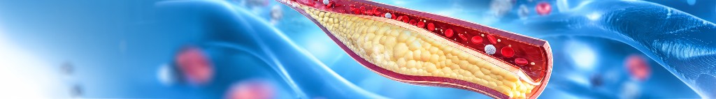 Artery cross-section showing plaque in coronary artery disease
